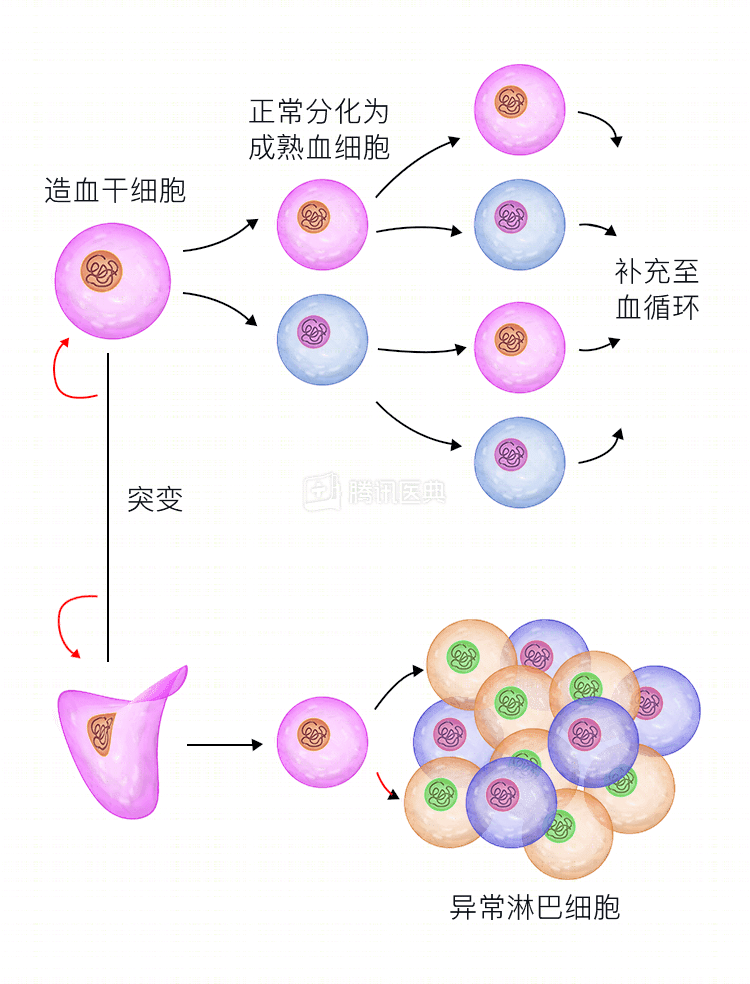 成人急性淋巴细胞白血病治疗 美国日本治疗成人急性淋巴细胞白血病 出境医