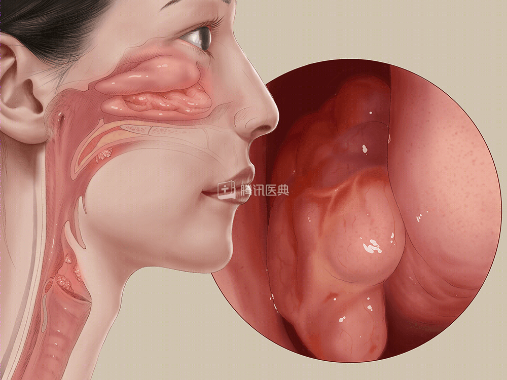 腾讯医典 乳突瘤是什么 飞巢网