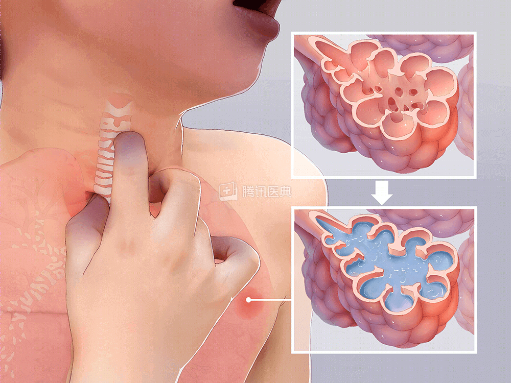 腾讯医典 Ards 竹尹网
