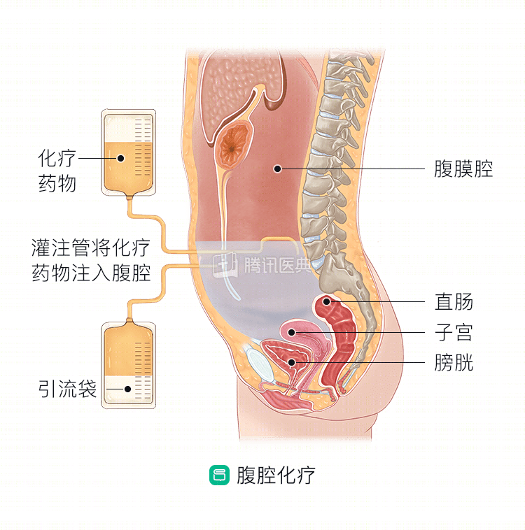 腹膜腔 子宮