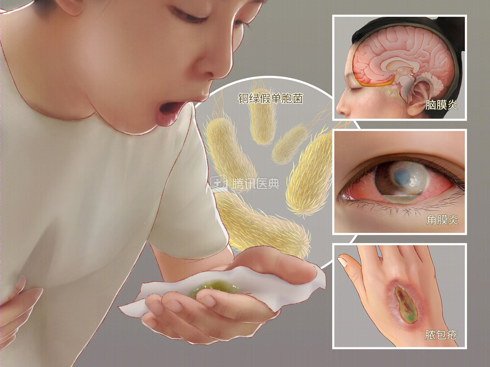 腾讯医典 假绿铜单胞菌感染症状 二安网