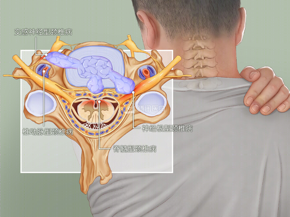 腾讯医典 颈椎病的临床分型及各型特点 丹若网