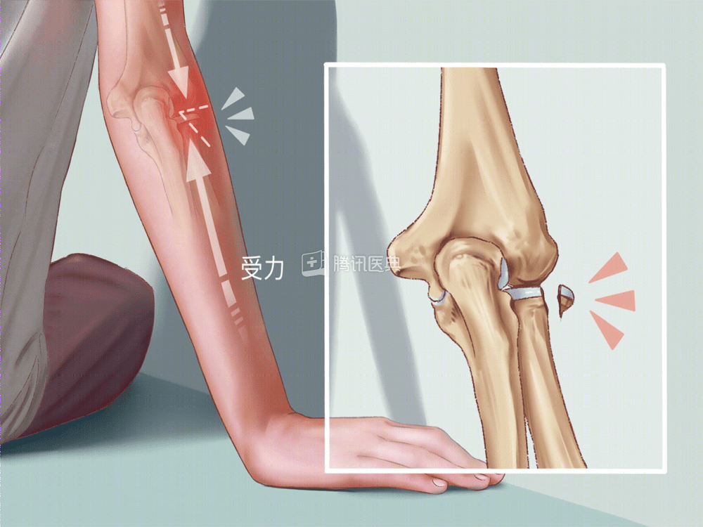 腾讯医典 桡骨头骨折多久能好 热啊网