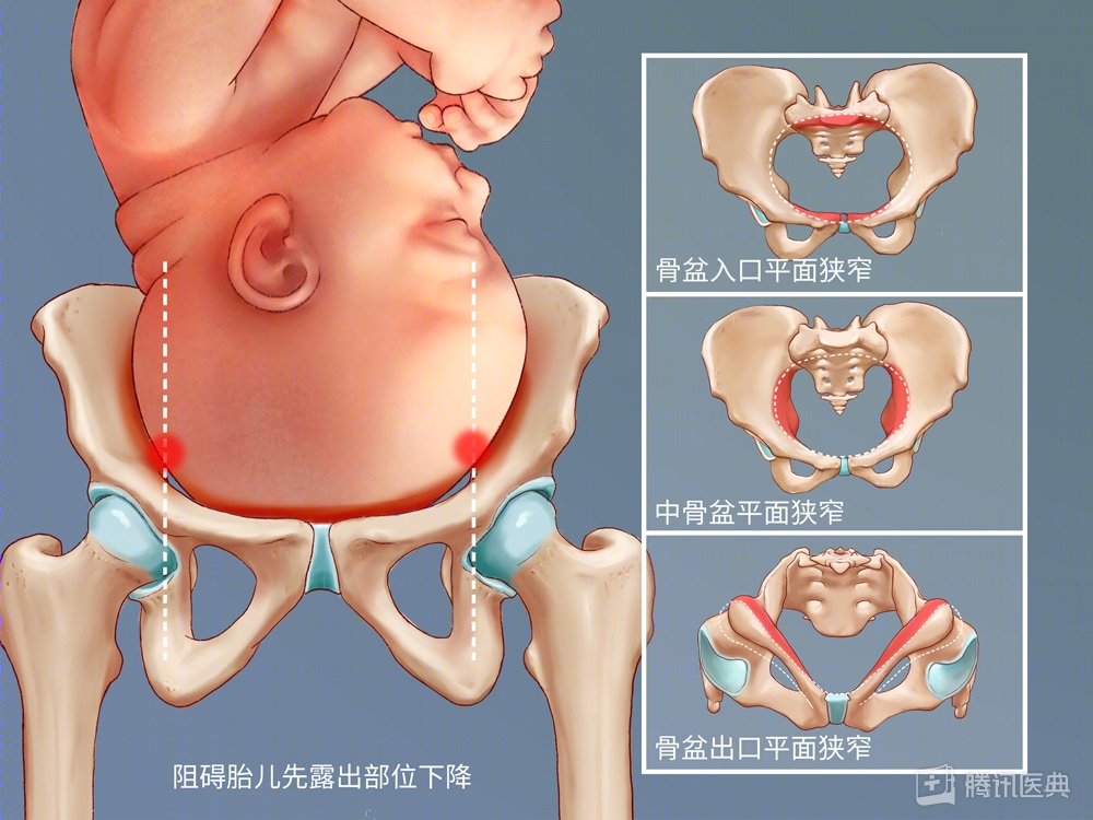 骨盆出口后矢状径图片