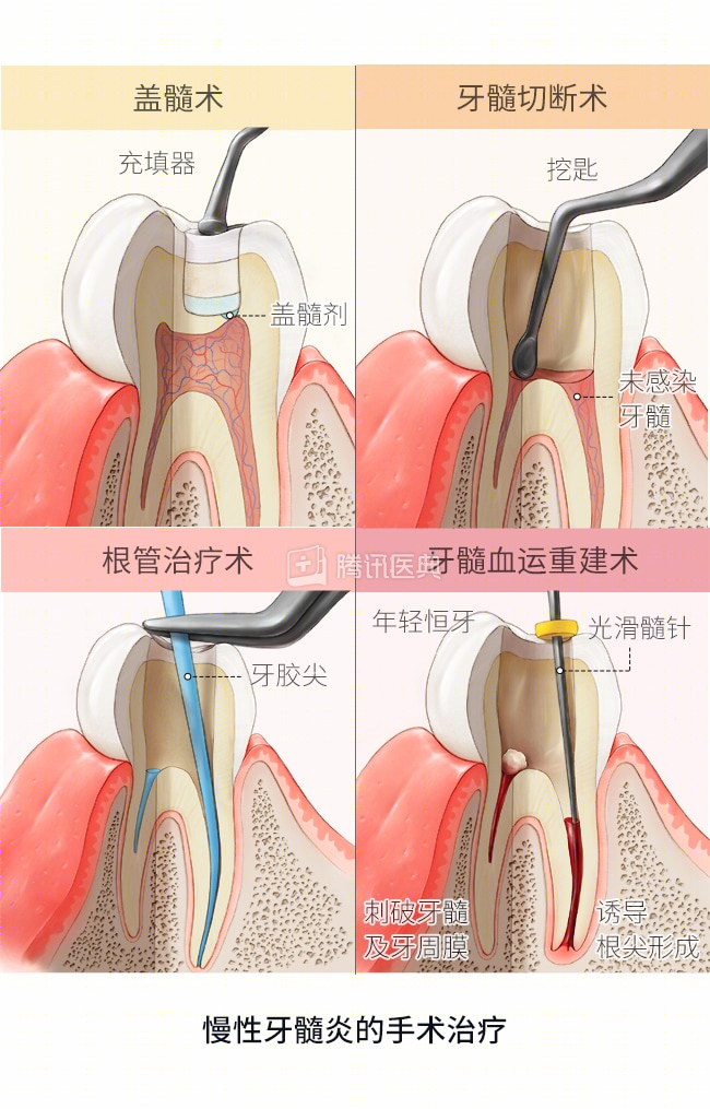 牙髓失活术图片